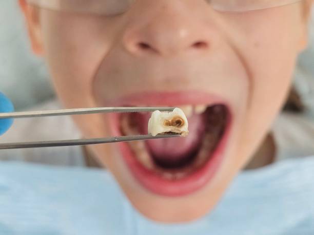 Best Emergency Gum Treatment in Townsend, MT